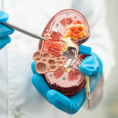 Manejo Integral de la Enfermedad Renal Crónica en CDMX